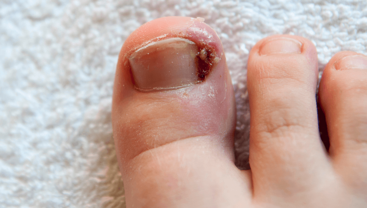 ¿Por qué se encarnan las uñas y qué puedes hacer?