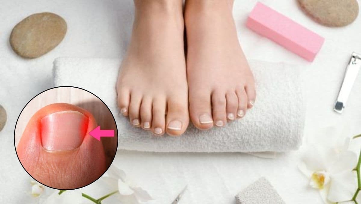 ¿Cómo sacar uñas enterradas con remedios caseros?