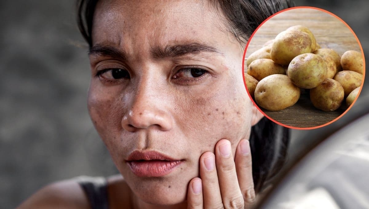 Cómo usar la papa para las manchas de la cara