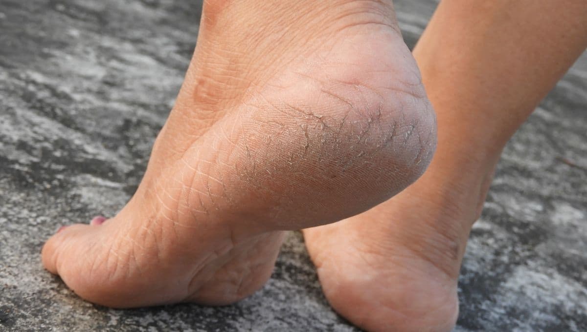 3 soluciones para olvidarte de los talones agrietados y presumir unos pies bellos