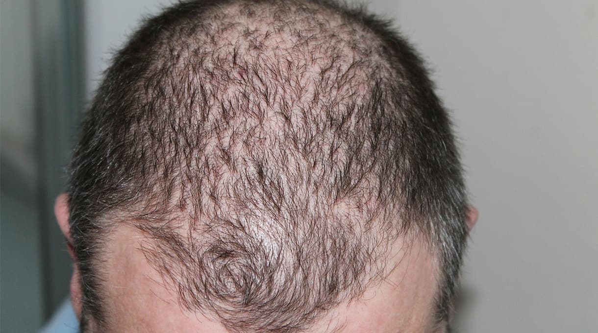 5 Remedios caseros para que salga cabello nuevo