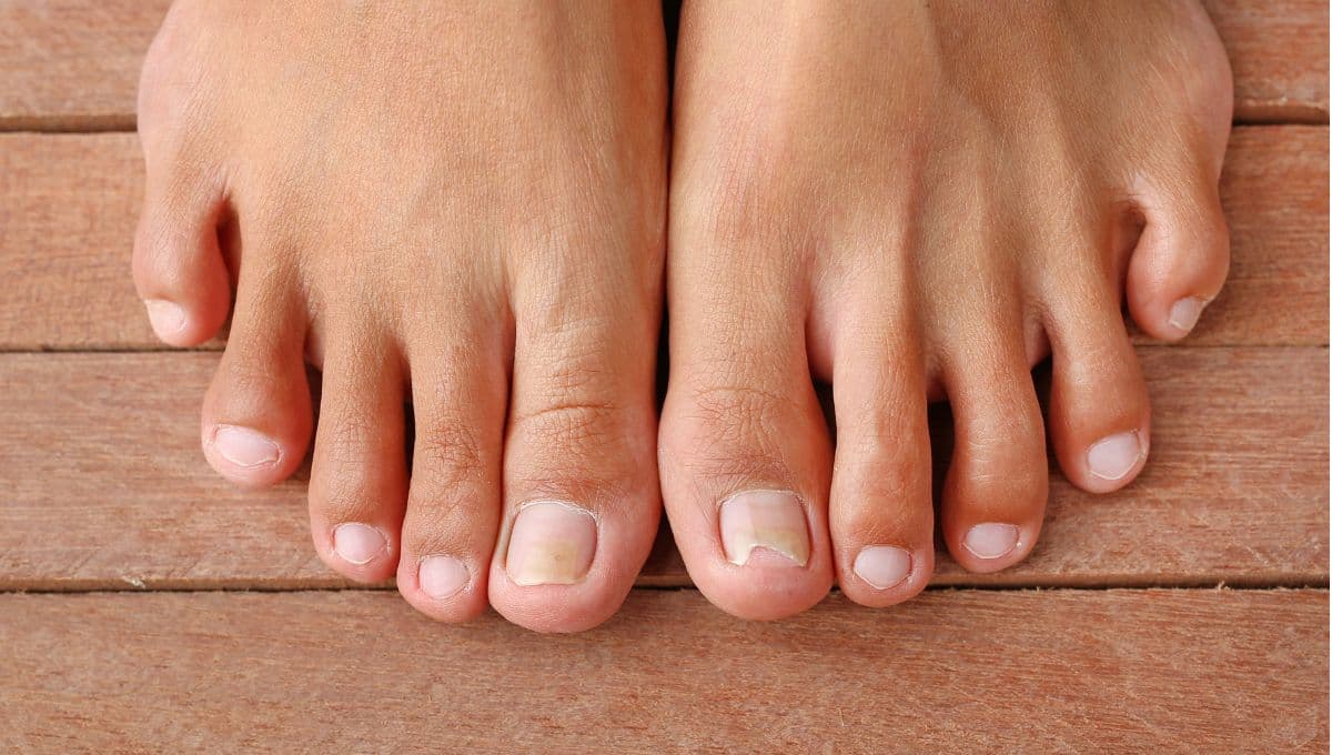 cómo eliminar hongos en las uñas con ciclopirox